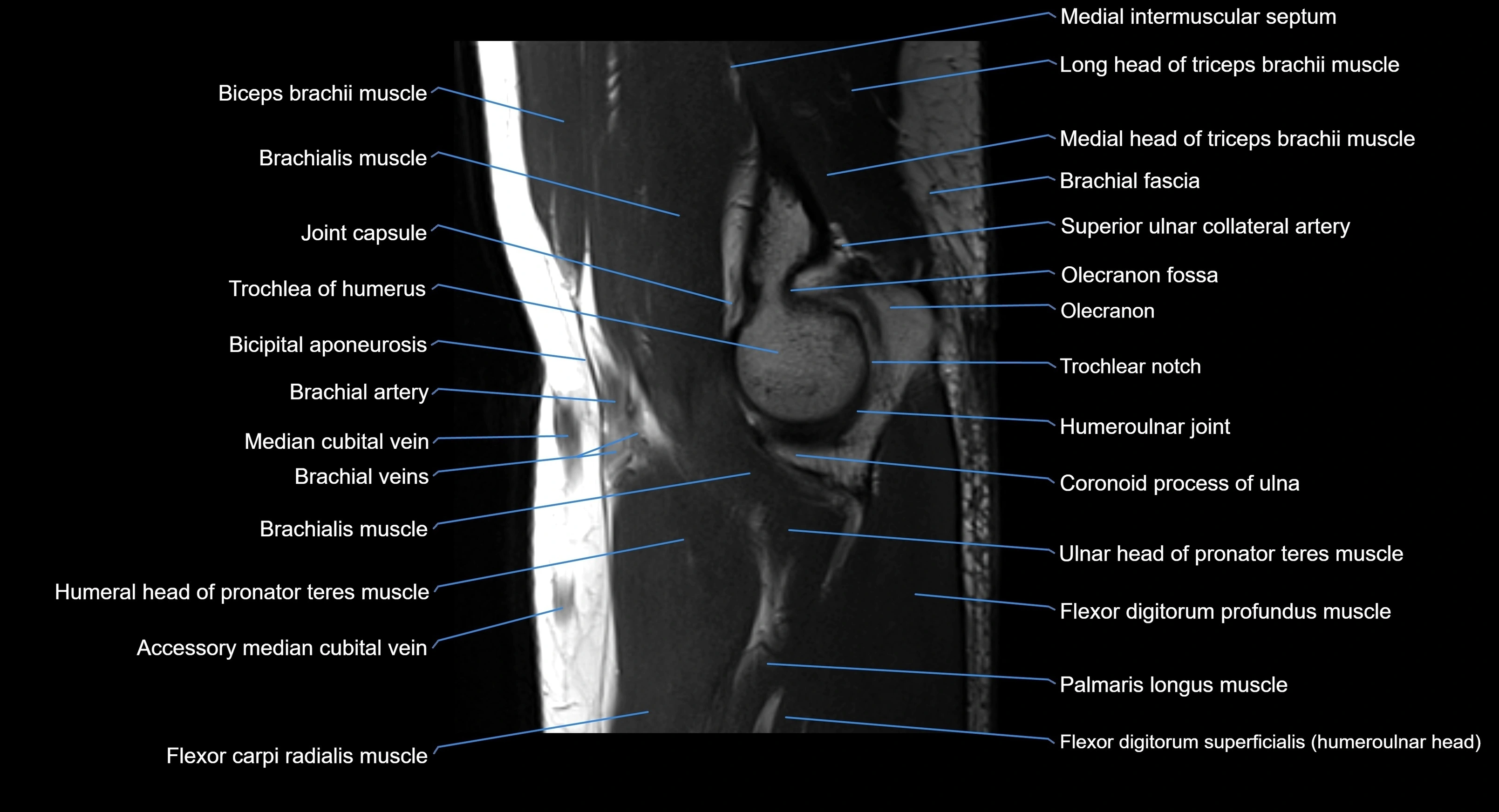 MRI elbow joint  sagittal cross sectional anatomy 3T  radiology  image-img-00001-00011.webp